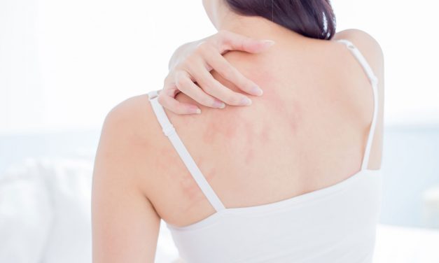 Dermatite atopica in estate: dalla ricerca Bioderma arriva la formulazione Skin Barrier Therapy